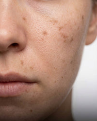 Pigmentation spots